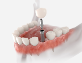 Yes_Desntistry dental implants Adelaide